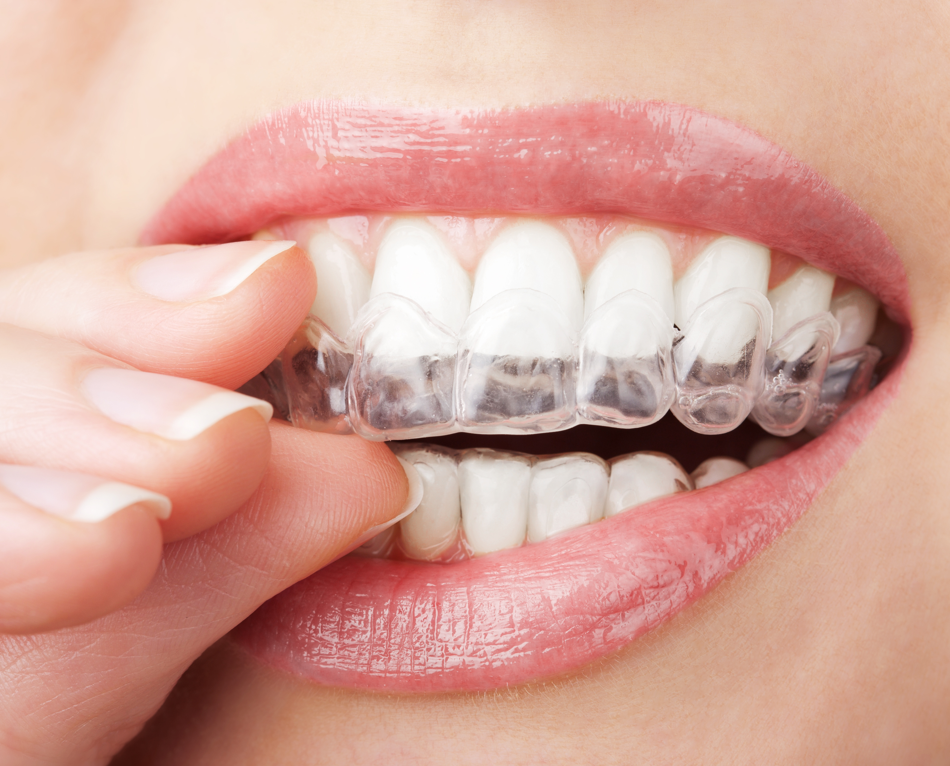 Consult an Orthodontist to Fix Your Dental Alignment Problems And Restore Smile
